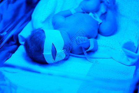 两天大的新生婴儿蓝色紫外线下拍照高清图片