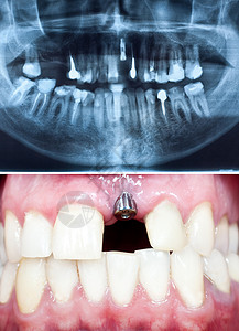口腔内种植牙的观镜头及其全景牙科高清图片
