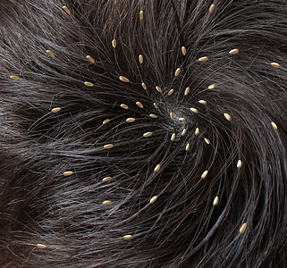 头虱医学与个人的头部,寄生的NITS卵孵化头皮附近虱子诊断预防治疗儿童成人的象征背景图片