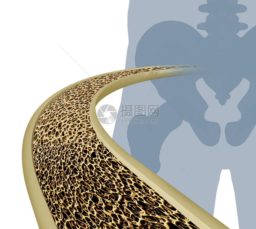 骨质疏松医学插图种近距离的人体骨内图,骨骼髋关节种正常的健康状况,逐渐降解为白色背景上的异常健康的骨量图片