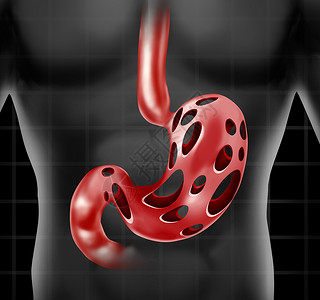 胃问题医疗保健人类消化器官,以孔洞为比喻,比喻腹部消化溃疡疼痛胃酸应激图片