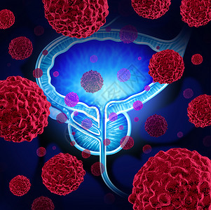 囊泡攻击前列腺癌危险医学男体内的癌细胞攻击生殖系统,人类恶肿瘤生长诊断治疗风险的象征背景