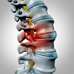 脊椎骨椎间盘突出的脊柱疼痛诊断人类脊柱系统的象征,医疗健康问题解剖符号与骨骼骨结构椎间盘特写背景