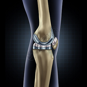 债权置换膝关节置换植入医学种人腿解剖后,假体手术肌肉骨骼疾病治疗符号的骨科三维插图元素背景
