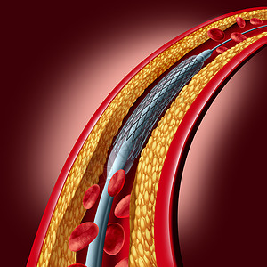 静脉血管支架冠状动脉放置种血管成形术医学植入物的,种心脏病治疗符号,植入动脉中,胆固醇斑块堵塞三维图示背景