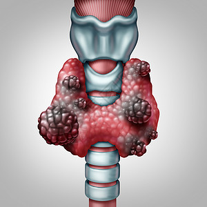 插图个甲状腺癌的个人类器官,恶肿瘤的生长内分泌系统疾病的象征,三维插图元素背景