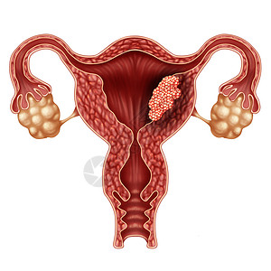 单角子宫子宫内膜癌子宫子宫癌的医学,女体内攻击生殖系统的癌细胞,宫颈肿瘤生长治疗诊断症状的标志,三维插图元素背景