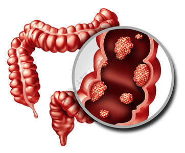 结肠息肉消化系统的恶肿瘤生长疾病三维插图背景