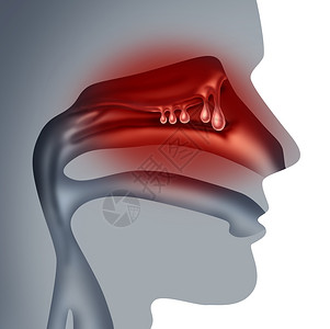 鼻息肉医学种非癌肿胀生长的人类鼻窦充血症状符号三维插图风格背景