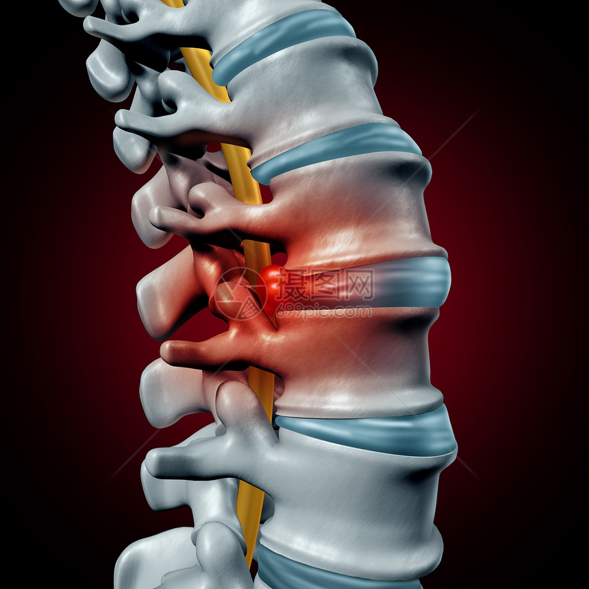 人椎间盘突出的脊柱疼痛诊断人类脊柱系统的符号医疗健康问题解剖符号,以骨骼骨结构椎间盘特写为三维插图图片