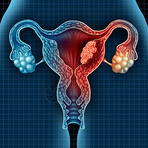 卵巢肿瘤子宫癌子宫内膜恶肿瘤种子宫医学,种危险的生长细胞女体内攻击生殖系统,宫颈疾病治疗诊断症状的标志,具背景