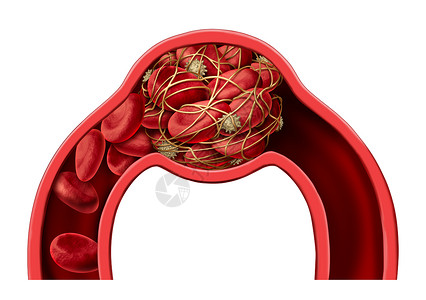 血栓医学三维插图图片