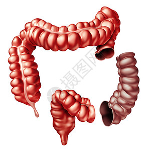 结肠切除术结肠手术医疗程序移除部分大肠三维肠图片
