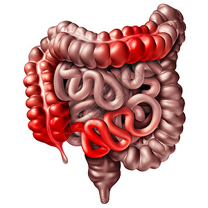克罗娜疾病克罗恩病医学人类肠道炎症症状引梗阻的三维图示图片