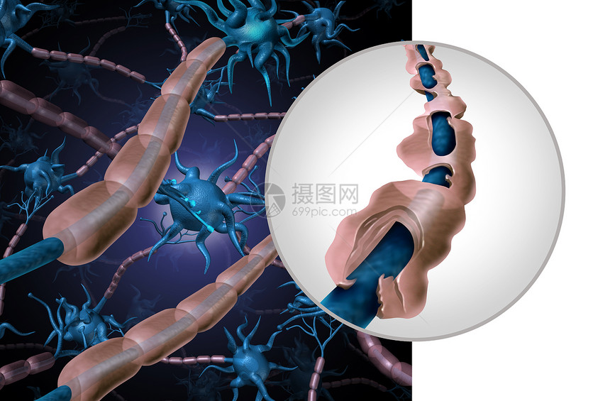 多发硬化髓鞘疾病MS自身免疫疾病与健康神经暴露纤维与瘢痕细胞鞘丢失三维图示图片