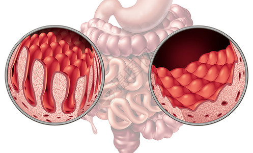 胃肠疾病腹腔腹腔肠道疾病解剖医学与正常绒毛受损的小肠衬里自身免疫疾病的消化系统,结肠胃三维插图背景