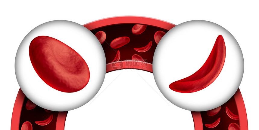 镰状细胞贫血种红细胞疾病,种正常异常的血红蛋白解剖医学插图三维渲染图片