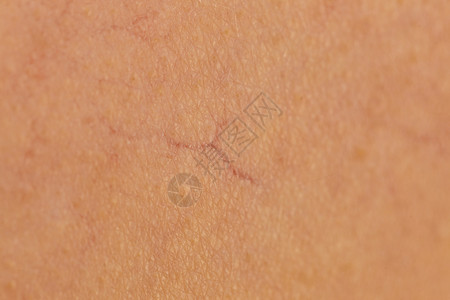 皮肤上皮肤病的人护肤问题的扩张的毛细血管,蜘蛛静脉,红色凸滑雪与扩张的毛细血管红色斑点背景图片