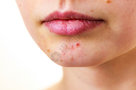 轻的女人露出脸上的痤疮痣,干燥的嘴唇十几岁的女孩下巴上没红色的斑点健康问题,皮肤病女部痤疮皮肤问题背景图片