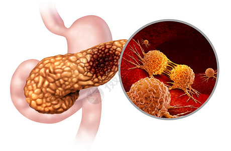 胃肠疾病胰腺癌解剖胰腺恶肿瘤符号消化腺体的部分,用三维插图元素恶肿瘤细胞进行显微放大背景