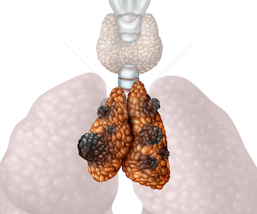 胸腺癌胸腺瘤胸腺癌疾病种腺体解剖疾病,随着恶变异细胞的生长,个图标,白色背景上分离,三维插图风格图片