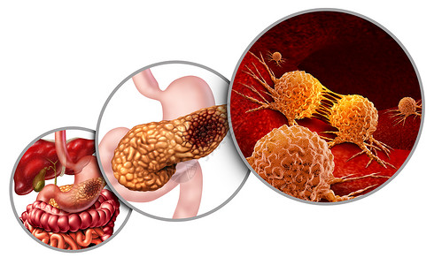 胃肠疾病胰腺癌解剖图胰腺恶肿瘤的,消化腺体部分的医学符号,显微放大突变细胞分裂扩散的三维插图元素背景