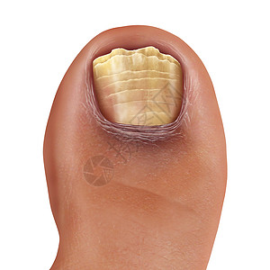 感染真菌脚趾甲脚感染甲真菌病癣脚趾甲足病与损害健康的人体解剖三维插图风格背景图片