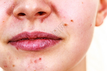 干燥的嘴唇女孩下巴痤疮青春痘背景图片