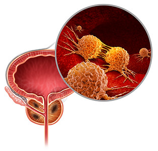 囊泡攻击前列腺癌的医学男体内的癌细胞攻击生殖系统,人类恶肿瘤生长的象征,诊断治疗风险与三维插图元素背景