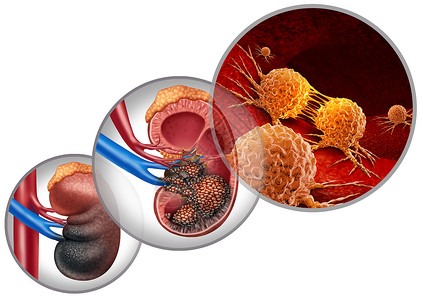 肾癌疾病医学人体恶细胞攻击泌尿系统肾癌解剖肿瘤生长治疗风险的标志与三维插图元素背景