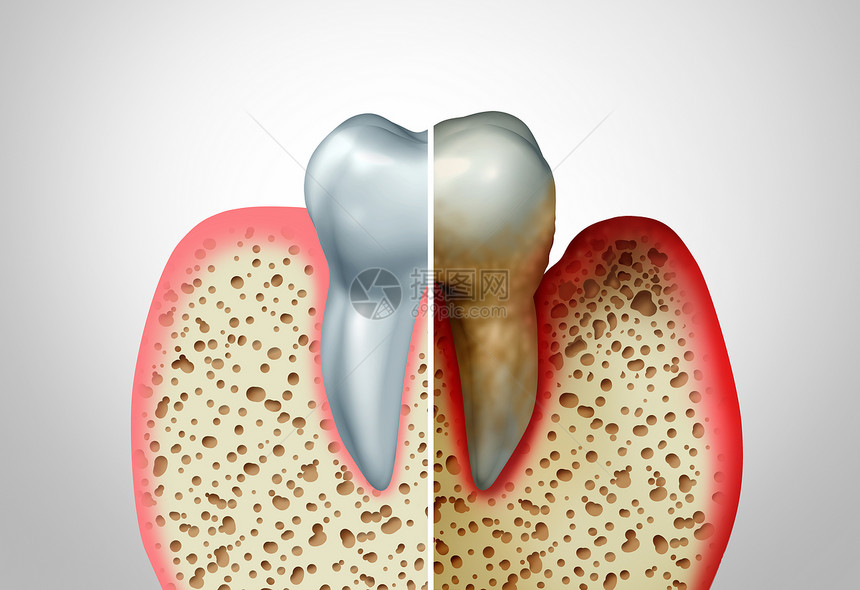 牙龈疾病与健康牙齿健康牙齿的比较,牙周炎良的口腔卫生健康问题细菌感染图的,以炎症为三维图图片