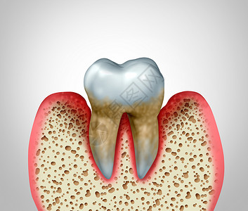 一颗牙齿牙周炎牙龈疾病口腔卫生良的健康问题细菌感染图的,以炎症为三维图背景