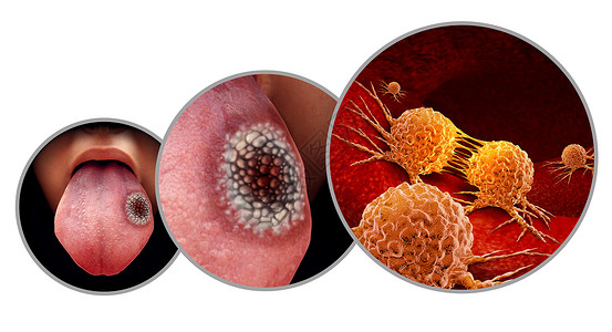 舌头溃疡舌癌医学鳞状细胞癌口腔恶肿瘤疾病与三维插图元素背景