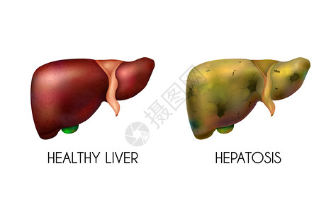 人体成分分析现实的人体内脏,肝脏,健康的,正常的,健康的脂肪成分,两种同的颜色,当疾病矢量插图插画
