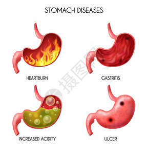 现实的人体内器官胃图标热症,火病,胃酸反流,腹部胀球,恶心矢量插图现实的人体内器官胃图标插画
