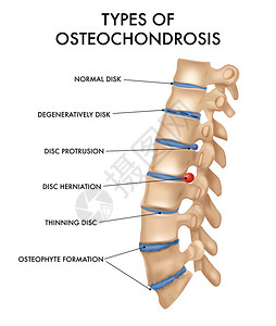 脊柱结构症状磁盘高清图片
