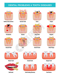 牙齿敏感口腔问题教育信息摄影集龋炎牙菌斑,口臭,搪瓷侵蚀矢量插图插画