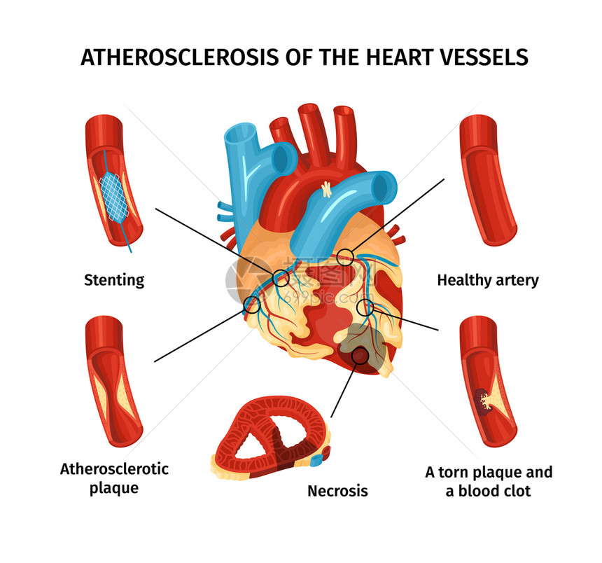 心脏血管动脉粥样硬化平信息图与标记的部分矢量插图图片