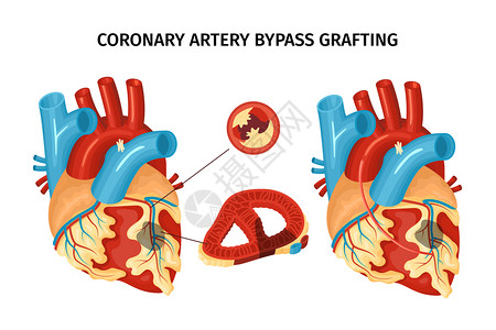 冠状动脉旁路移植术平矢量图示心脏解剖图片