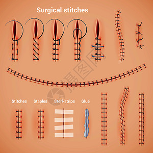 史泰登手术缝合缝合线真实的缝合方法形状与订书机胶水文本标题矢量插图插画