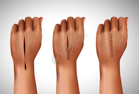 伤口有很多划痕手术缝合缝合线的真实成与图像的人手同阶段的缝合矢量插图插画
