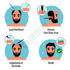 毛囊图标与胡须男子头发移植过程的阶段分离矢量插图插画