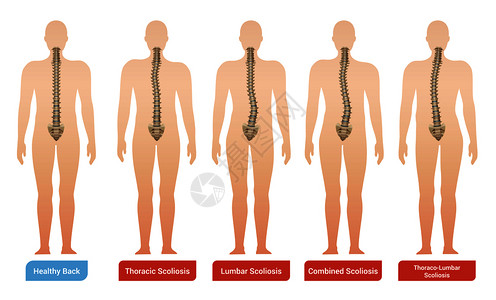 人体曲线脊柱弯曲脊柱侧凸医学信息图像与人体轮廓脊柱文本矢量插图插画