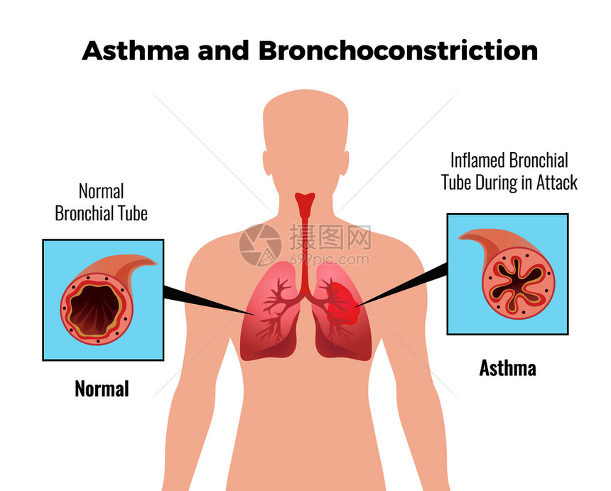 哮喘发作医学教育图表海报与描绘正常发炎的支气管平向量插图图片