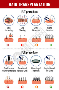 头发移植的方法与程序信息的阶段白色背景矢量插图图片
