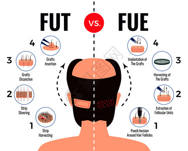头发移植的方法,未来与FUE海报与信息素白色背景矢量插图图片