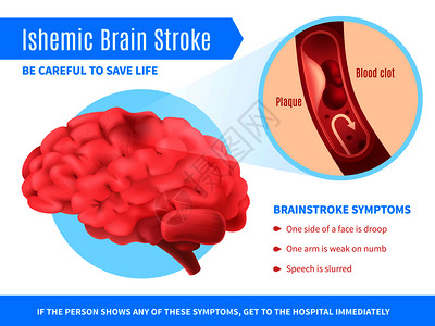 动脉斑块缺血脑卒中现实海报与症状清单,并呼吁小心拯救生命矢量插图缺血脑卒中海报插画