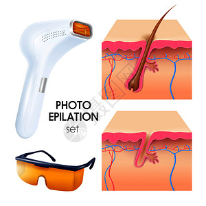照片脱毛逼真与脱毛保护护目镜横截的皮肤层方案矢量插图照片脱毛写实套装背景图片