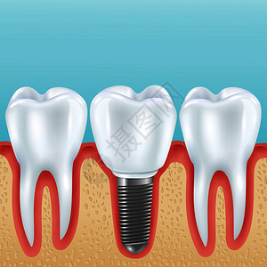 亚冠牙科假肢现实向量插图与健康牙齿义齿冠植入种植体种植牙的现实插图插画