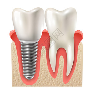 牙种植体牙套闭合模型牙种植体牙套模型特写侧视真实图像矢量图背景图片